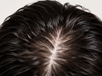 Close-up of a man's scalp and hair parting